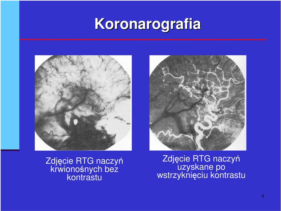 kontrastu Zdjcie RTG naczy