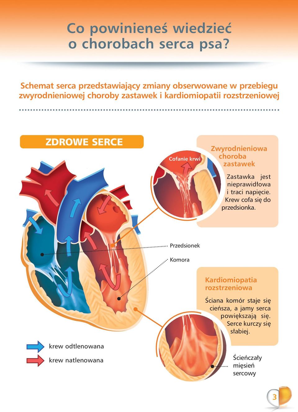 rozstrzeniowej ZDROWE SERCE Cofanie krwi Zwyrodnieniowa choroba zastawek Zastawka jest nieprawid owa i traci napi cie.