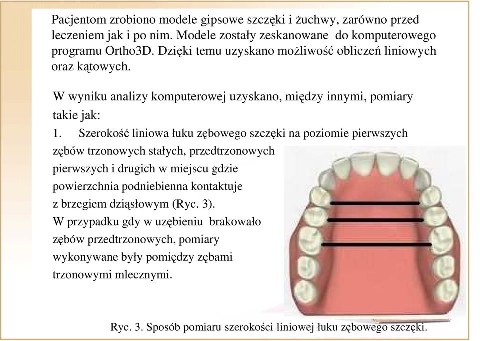 Szerokość liniowa łuku zębowego szczęki na poziomie pierwszych zębów trzonowych stałych, przedtrzonowych pierwszych i drugich w miejscu gdzie powierzchnia podniebienna