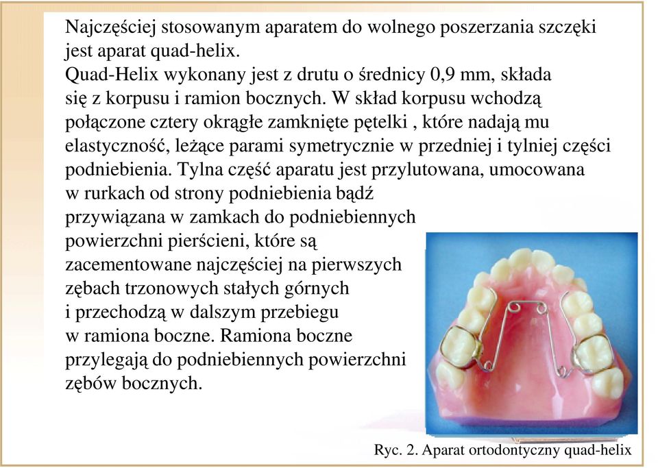 Tylna część aparatu jest przylutowana, umocowana w rurkach od strony podniebienia bądź przywiązana w zamkach do podniebiennych powierzchni pierścieni, które są zacementowane najczęściej