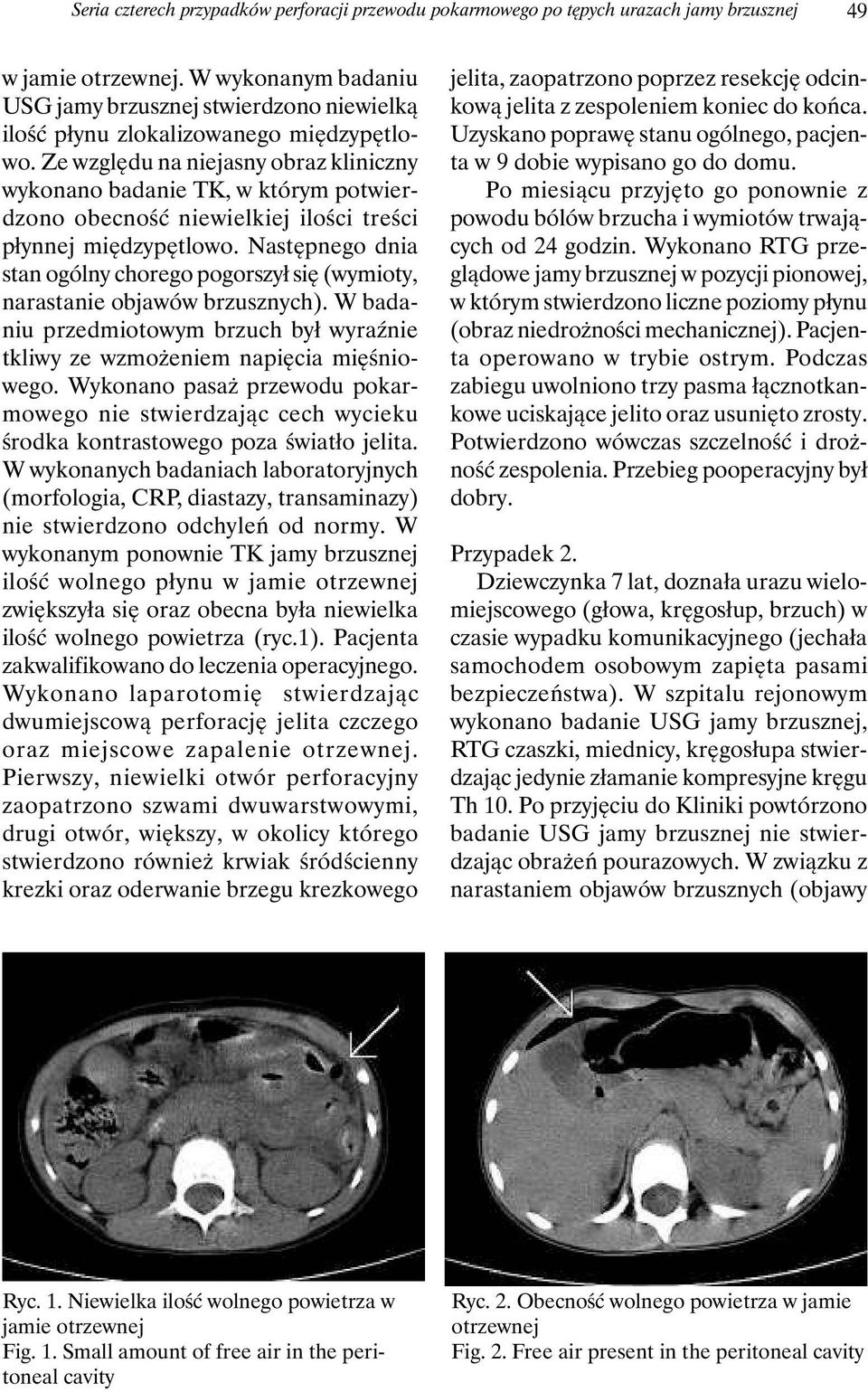 Ze względu na niejasny obraz kliniczny wykonano badanie TK, w którym potwierdzono obecność niewielkiej ilości treści płynnej międzypętlowo.