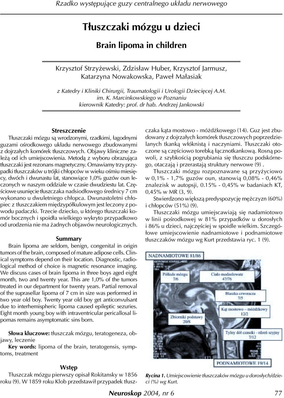 Andrzej Jankowski Streszczenie T³uszczaki mózgu s¹ wrodzonymi, rzadkimi, ³agodnymi guzami oœrodkowego uk³adu nerwowego zbudowanymi z dojrza³ych komórek t³uszczowych.
