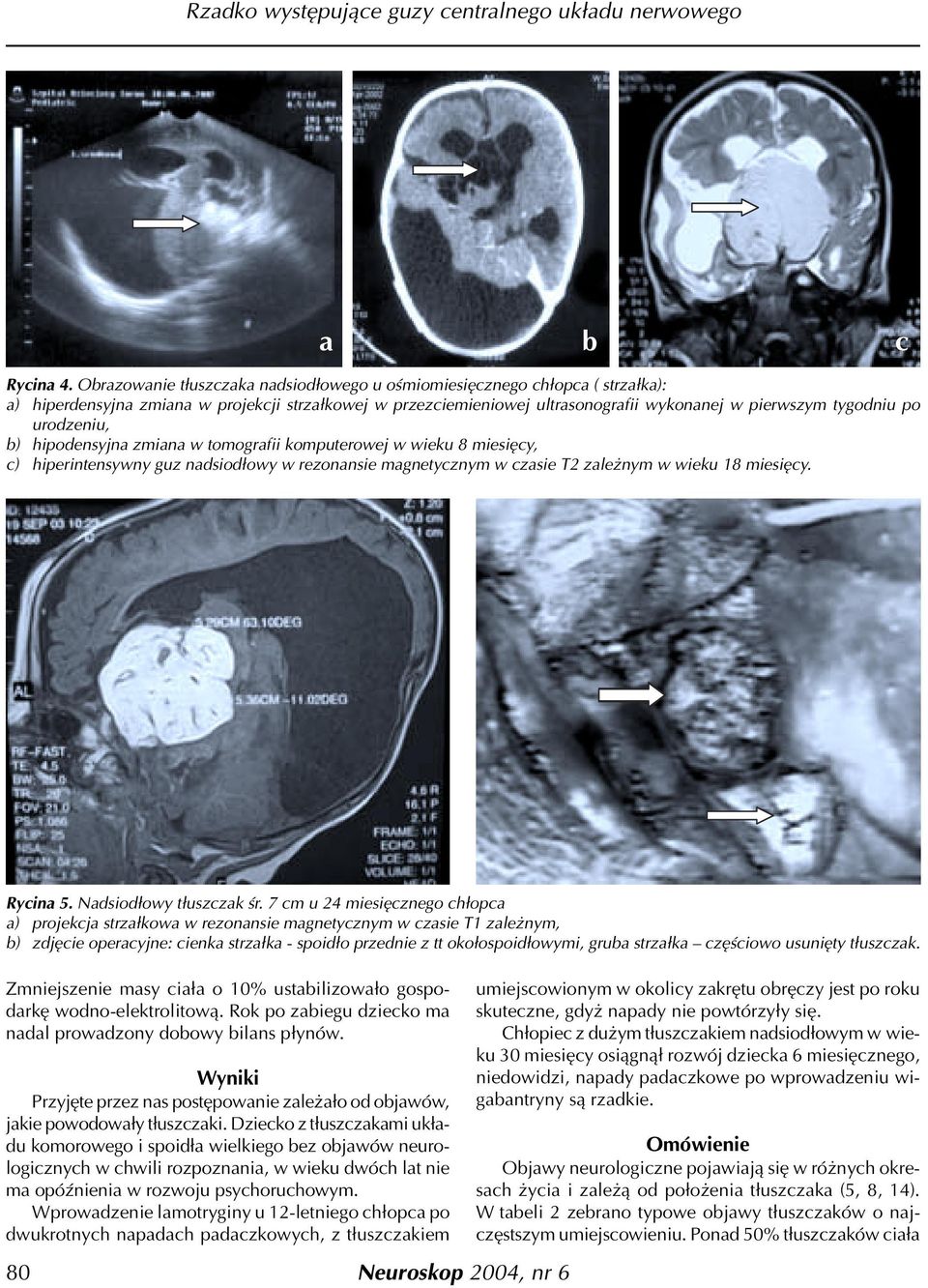 urodzeniu, b) hipodensyjna zmiana w tomografii komputerowej w wieku 8 miesiêcy, c) hiperintensywny guz nadsiod³owy w rezonansie magnetycznym w czasie T2 zale nym w wieku 18 miesiêcy. Rycina 5.