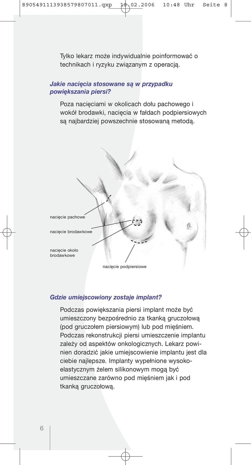 nacięcie pachowe nacięcie brodawkowe nacięcie około brodawkowe nacięcie podpiersiowe Gdzie umiejscowiony zostaje implant?