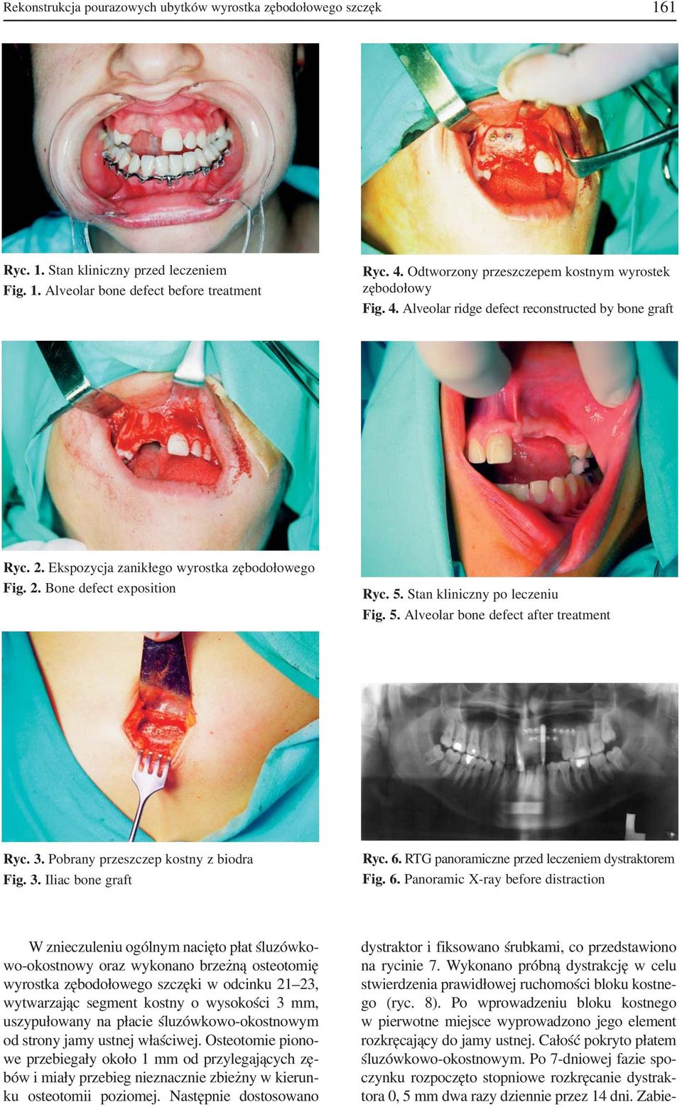 Stan kliniczny po leczeniu Fig. 5. Alveolar bone defect after treatment Ryc. 3. Pobrany przeszczep kostny z biodra Fig. 3. Iliac bone graft Ryc. 6. RTG panoramiczne przed leczeniem dystraktorem Fig.