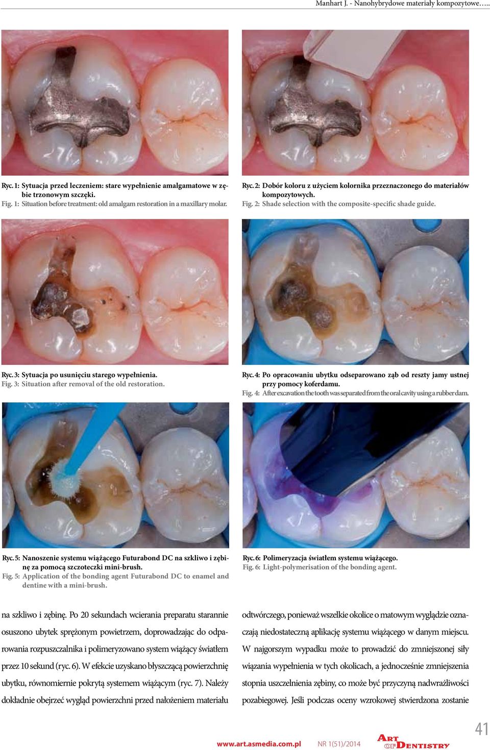 2: Shade selection with the composite-specific shade guide. Ryc. 3: Sytuacja po usunięciu starego wypełnienia. Fig. 3: Situation after removal of the old restoration. Ryc. 4: Po opracowaniu ubytku odseparowano ząb od reszty jamy ustnej przy pomocy koferdamu.