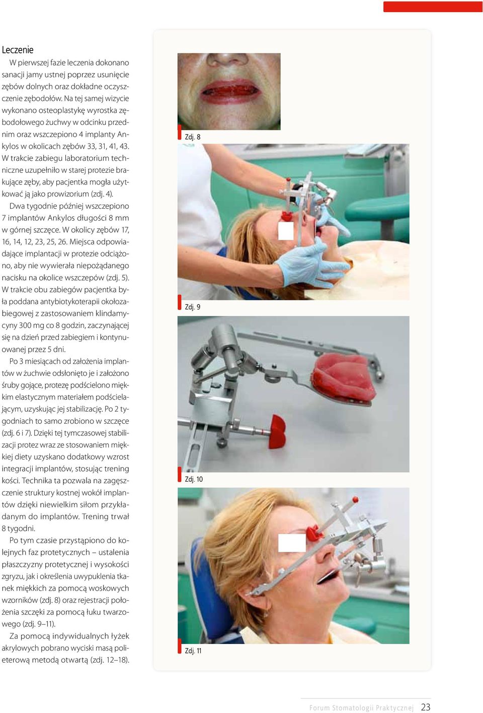 W trakcie zabiegu laboratorium techniczne uzupełniło w starej protezie brakujące zęby, aby pacjentka mogła użytkować ją jako prowizorium (zdj. 4).