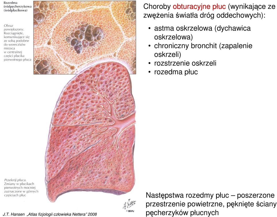 rozstrzenie oskrzeli rozedma płuc J.T.