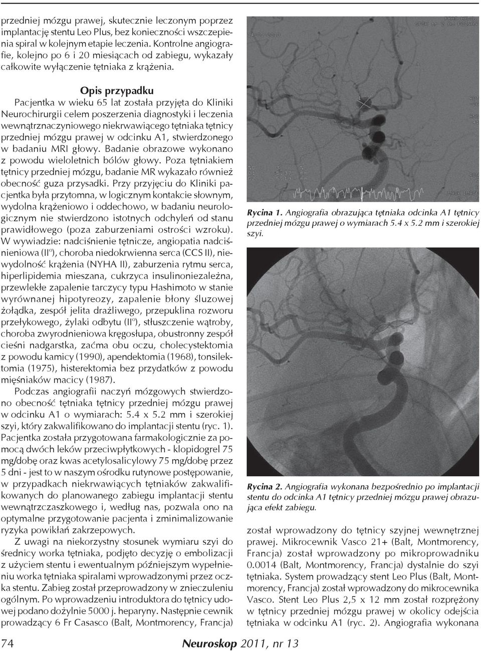 Opis przypadku Pacjentka w wieku 65 lat została przyjęta do Kliniki Neurochirurgii celem poszerzenia diagnostyki i leczenia wewnątrznaczyniowego niekrwawiącego tętniaka tętnicy przedniej mózgu prawej