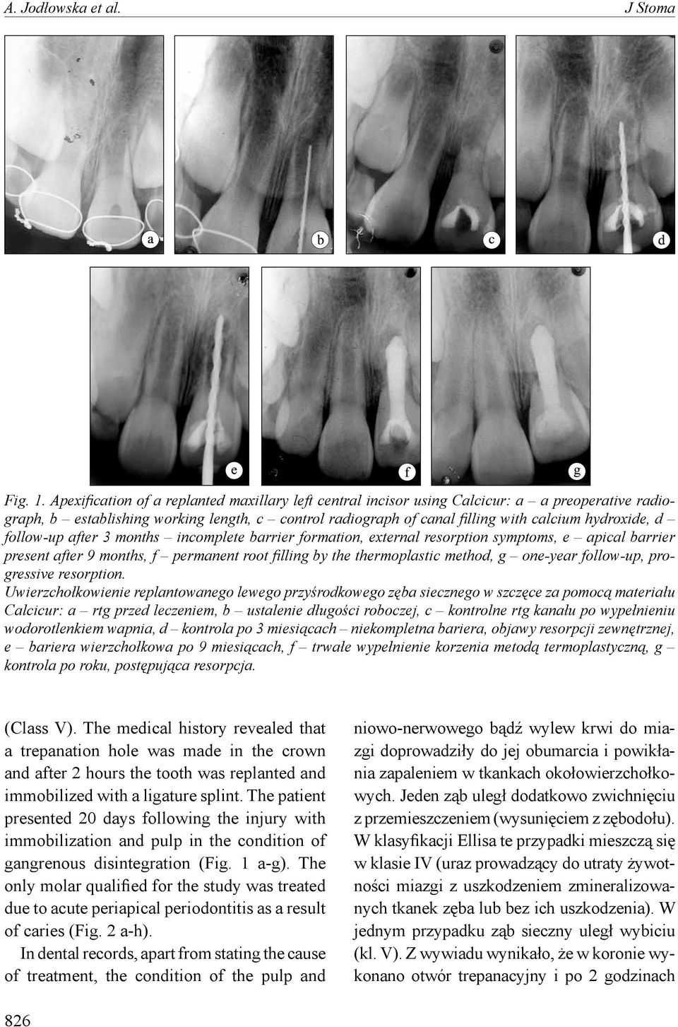 follow-up after 3 months incomplete barrier formation, external resorption symptoms, e apical barrier present after 9 months, f permanent root filling by the thermoplastic method, g one-year