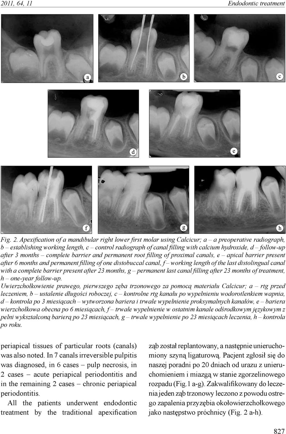 follow-up after 3 months complete barrier and permanent root filling of proximal canals, e apical barrier present after 6 months and permanent filling of one distobuccal canal, f working length of