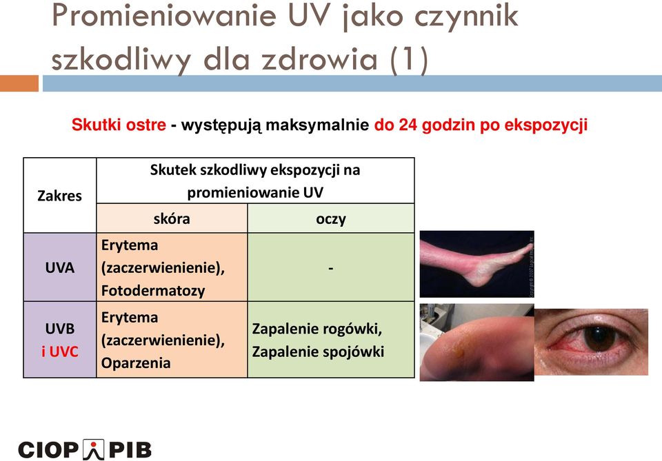 szkodliwy ekspozycji na promieniowanie UV skóra Erytema (zaczerwienienie),