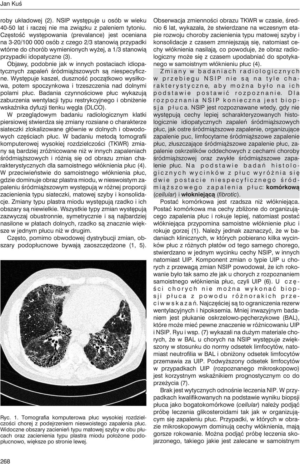 Objawy, podobnie jak w innych postaciach idiopatycznych zapaleń śródmiąższowych są niespecyficzne.