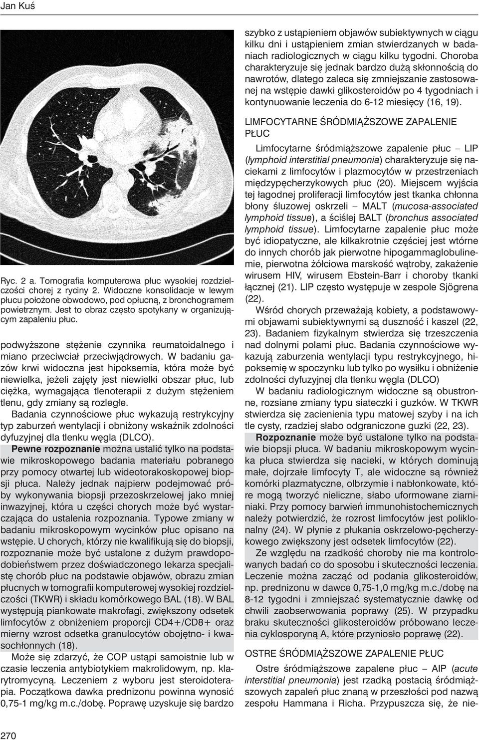 miesięcy (16, 19). Ryc. 2 a. Tomografia komputerowa płuc wysokiej rozdzielczości chorej z ryciny 2. Widoczne konsolidacje w lewym płucu położone obwodowo, pod opłucną, z bronchogramem powietrznym.