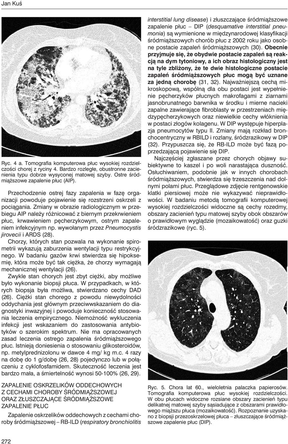 Zmiany w obrazie radiologicznym w przebiegu AIP należy różnicować z biernym przekrwieniem płuc, krwawieniem pęcherzykowym, ostrym zapaleniem infekcyjnym np.
