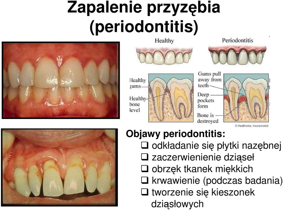 zaczerwienienie dziąseł obrzęk tkanek miękkich