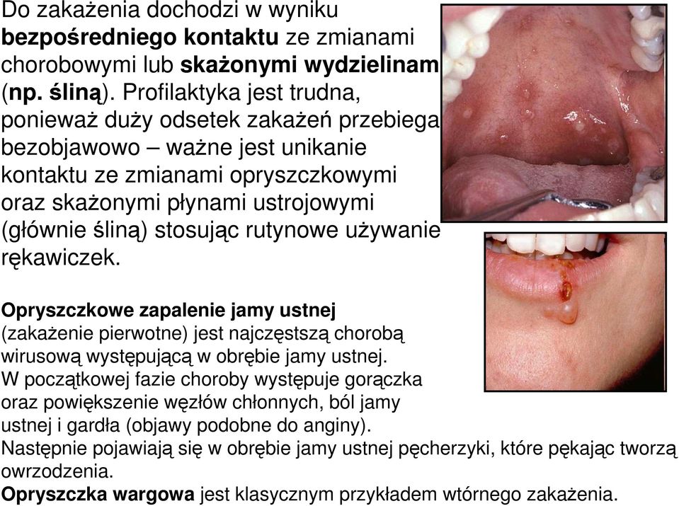 stosując rutynowe uŝywanie rękawiczek. Opryszczkowe zapalenie jamy ustnej (zakaŝenie pierwotne) jest najczęstszą chorobą wirusową występującą w obrębie jamy ustnej.