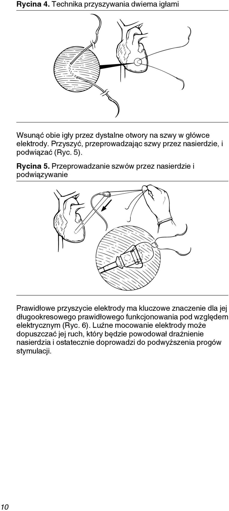 Przeprowadzanie szwów przez nasierdzie i podwiązywanie Prawidłowe przyszycie elektrody ma kluczowe znaczenie dla jej długookresowego