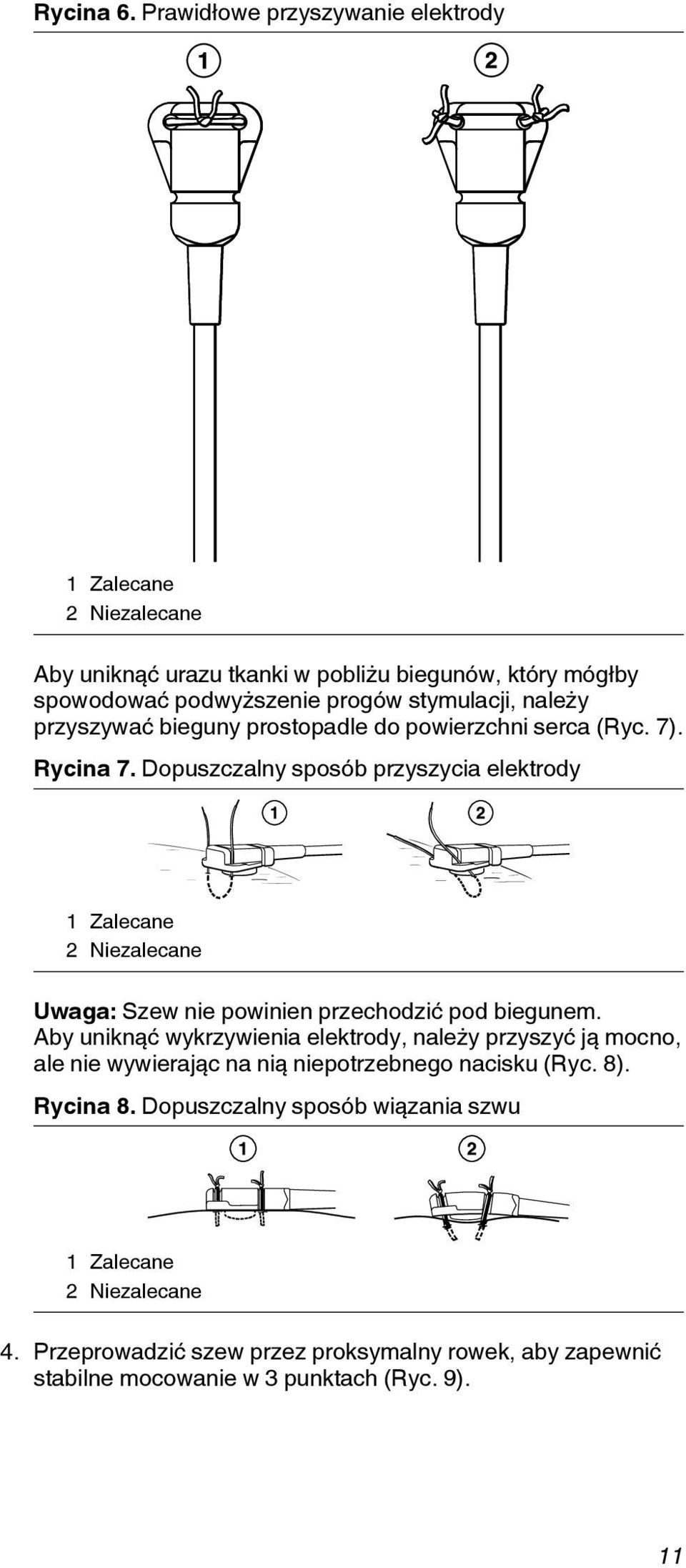 należy przyszywać bieguny prostopadle do powierzchni serca (Ryc. 7). Rycina 7.