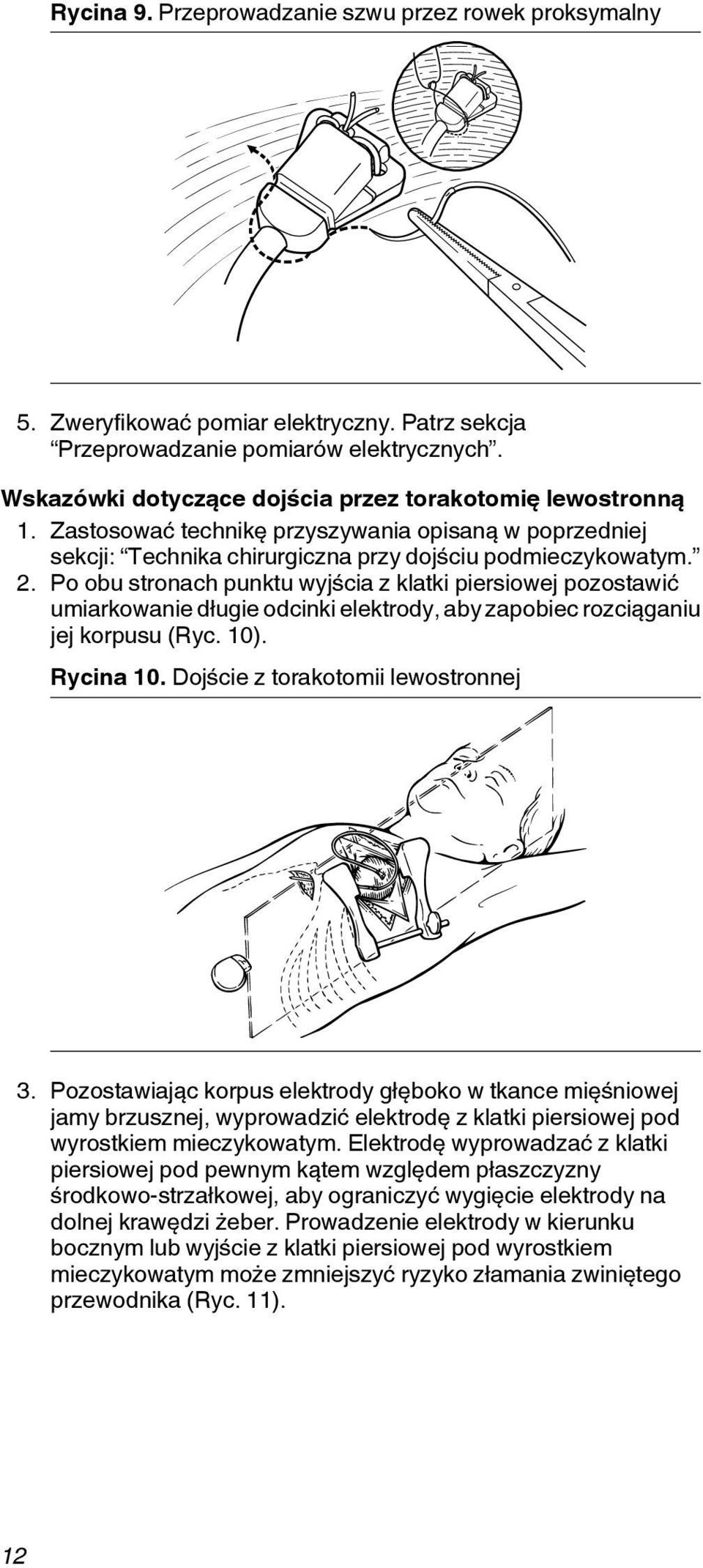 Po obu stronach punktu wyjścia z klatki piersiowej pozostawić umiarkowanie długie odcinki elektrody, aby zapobiec rozciąganiu jej korpusu (Ryc. 10). Rycina 10. Dojście z torakotomii lewostronnej 3.