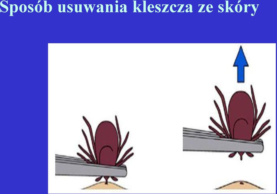 kleszcza