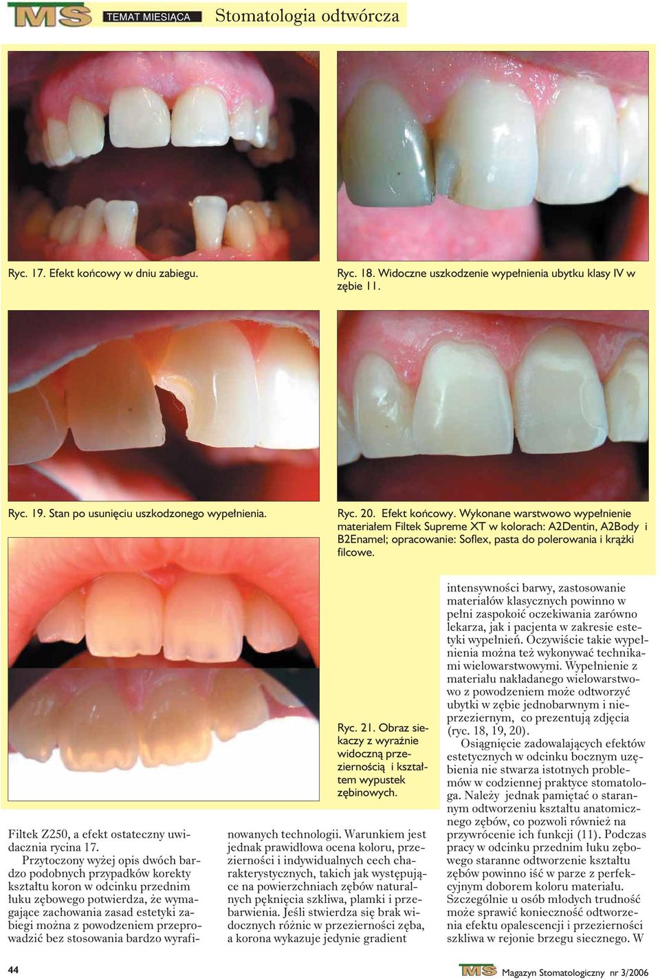 Filtek Z250, a efekt ostateczny uwidacznia rycina 17.