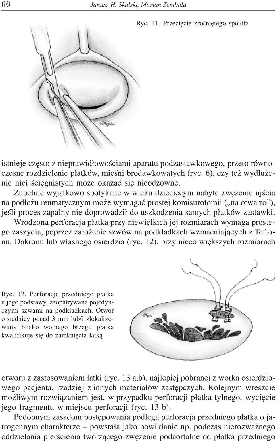 6), czy te wyd³u enie nici œciêgnistych mo e okazaæ siê nieodzowne.