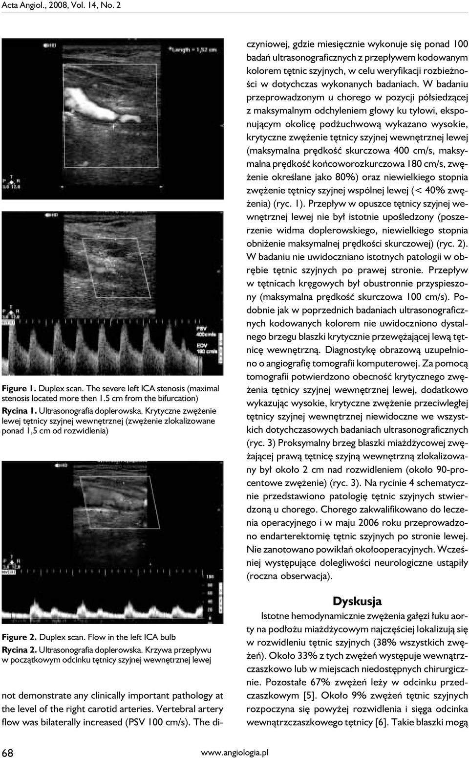 Krzywa przepływu w początkowym odcinku tętnicy szyjnej wewnętrznej lewej not demonstrate any clinically important pathology at the level of the right carotid arteries.