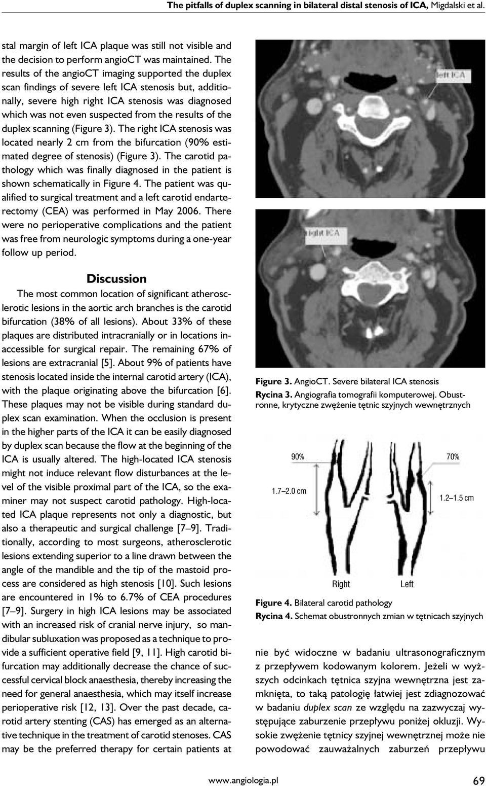 results of the duplex scanning (Figure 3). The right ICA stenosis was located nearly 2 cm from the bifurcation (90% estimated degree of stenosis) (Figure 3).