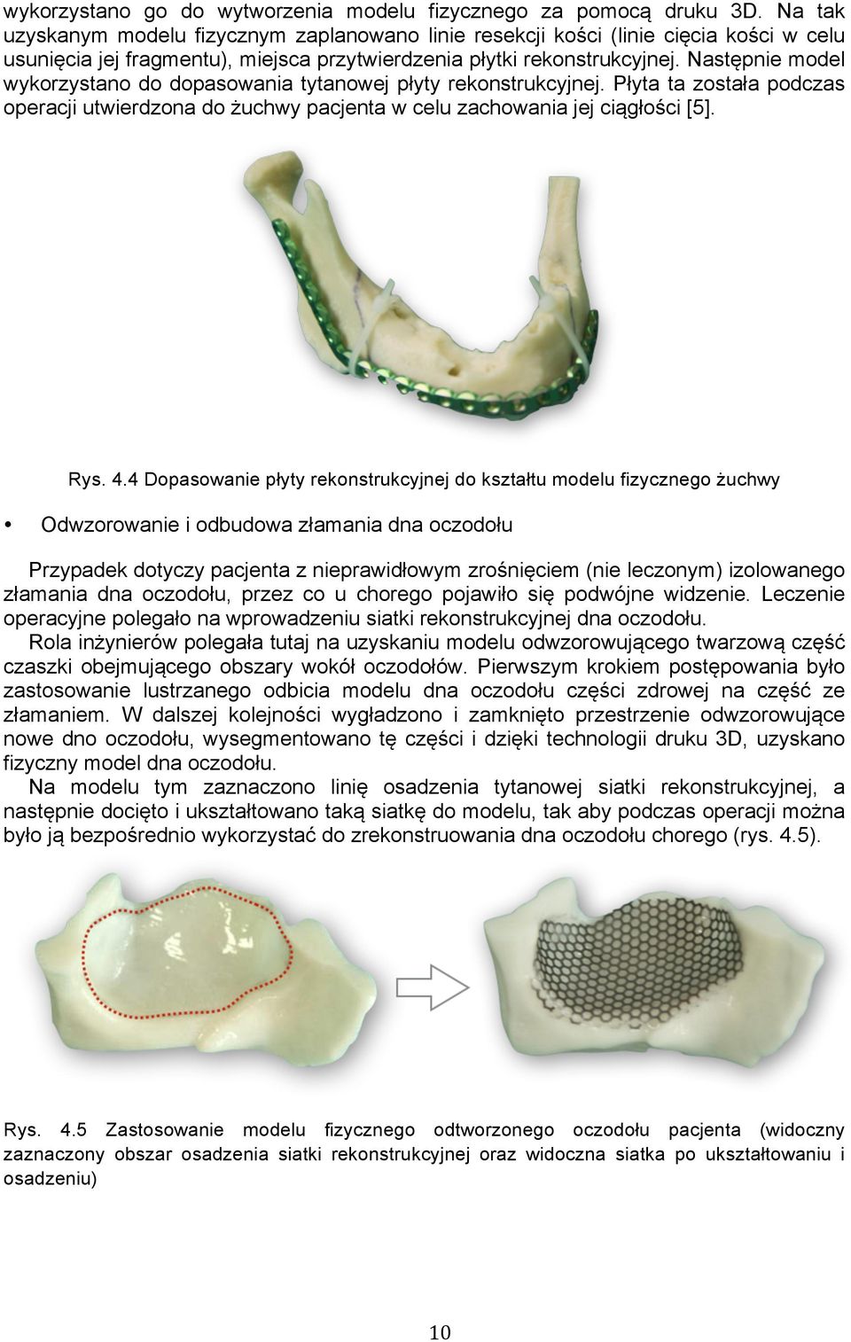 Następnie model wykorzystano do dopasowania tytanowej płyty rekonstrukcyjnej. Płyta ta została podczas operacji utwierdzona do żuchwy pacjenta w celu zachowania jej ciągłości [5]. Rys. 4.