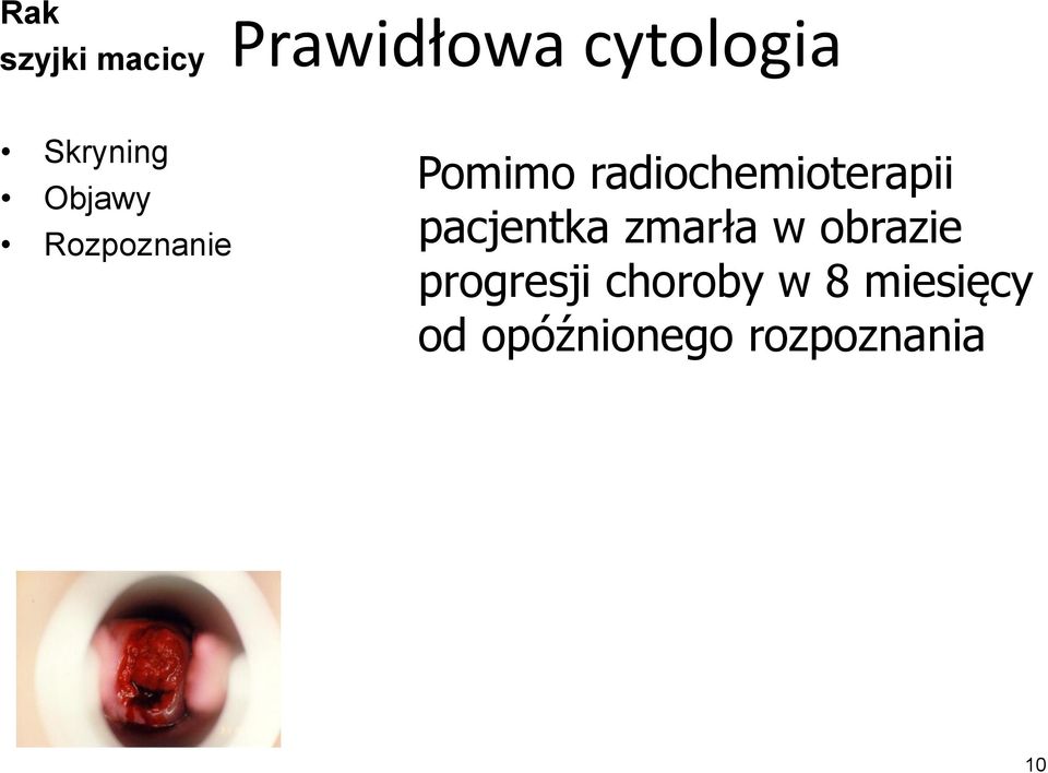 zmarła w obrazie progresji choroby w