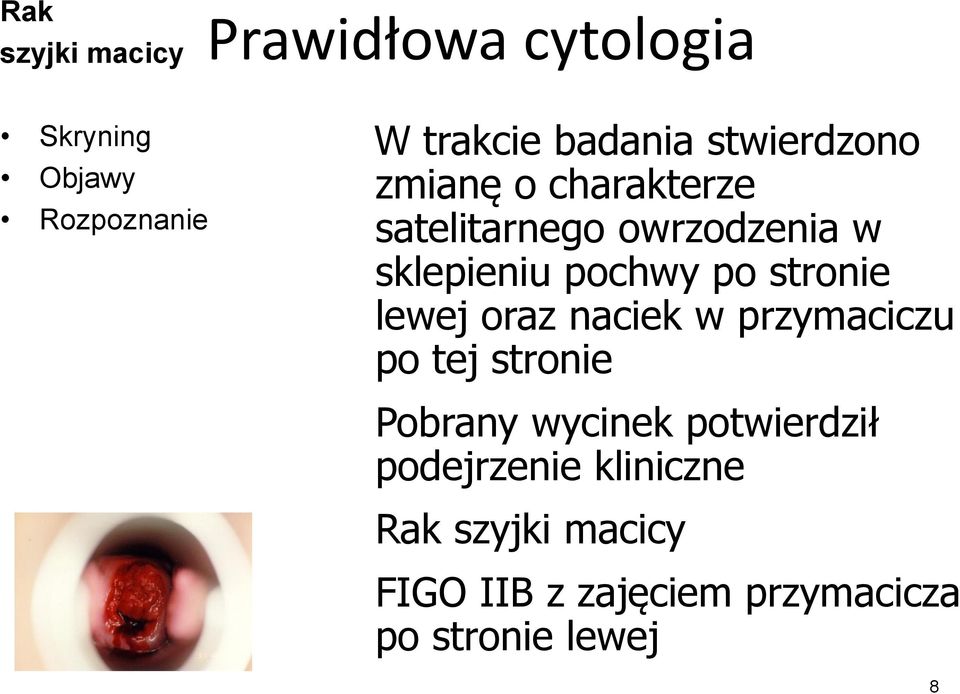 oraz naciek w przymaciczu po tej stronie Pobrany wycinek potwierdził