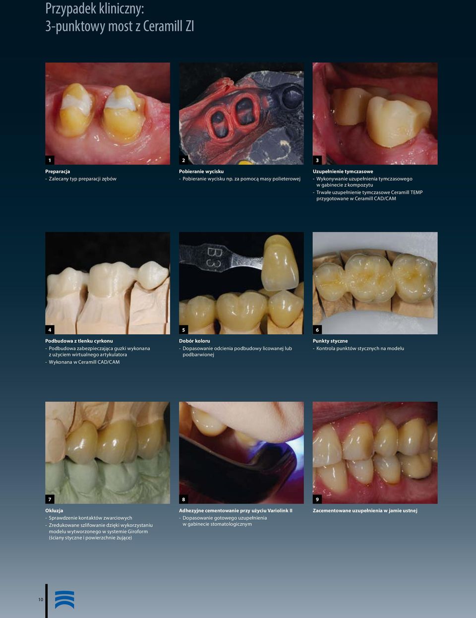 Podbudowa z tlenku cyrkonu - Podbudowa zabezpieczająca guzki wykonana z użyciem wirtualnego artykulatora - Wykonana w Ceramill CAD/CAM 5 Dobór koloru - Dopasowanie odcienia podbudowy licowanej lub