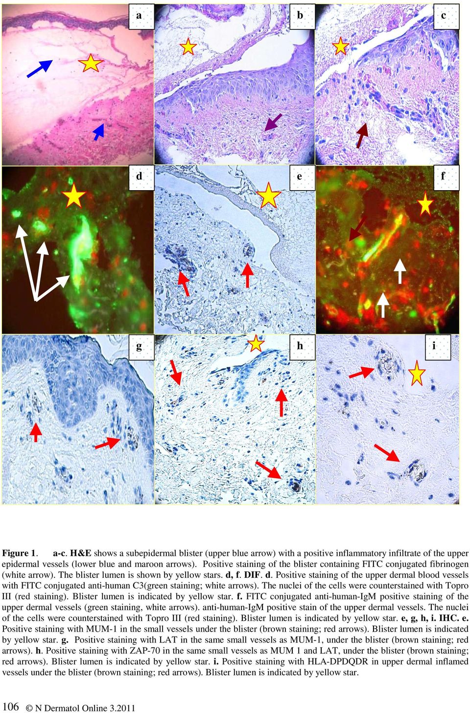 conjugated anti-human C3(green staining; white arrows) The nuclei of the cells were counterstained with Topro III (red staining) Blister lumen is indicated by yellow star f FITC conjugated