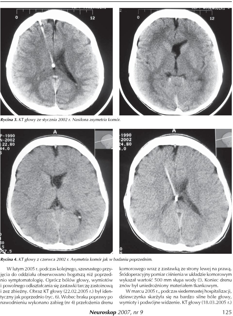 Oprócz bólów głowy, wymiotów i powolnego odkształcania się zastawki tarczę zastoinową i zez zbieżny. Obraz KT głowy (22.02.2005 r.) był identyczny jak poprzednio (ryc. 6).