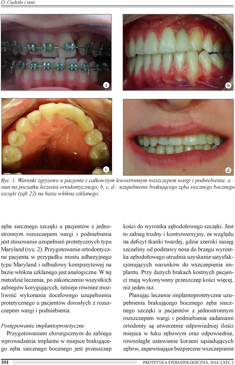 (ząb 22) na bazie włókna szklanego. zęba siecznego szczęki u pacjentów z jednostronnym rozszczepem wargi i podniebienia jest stosowanie uzupełnień protetycznych typu Maryland (ryc. 2).