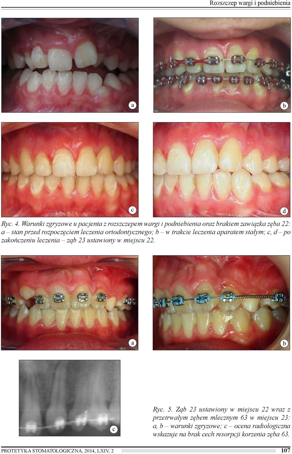 leczenia ortodontycznego; b w trakcie leczenia aparatem stałym; c, d po zakończeniu leczenia ząb 23 ustawiony w miejscu 22. Ryc.