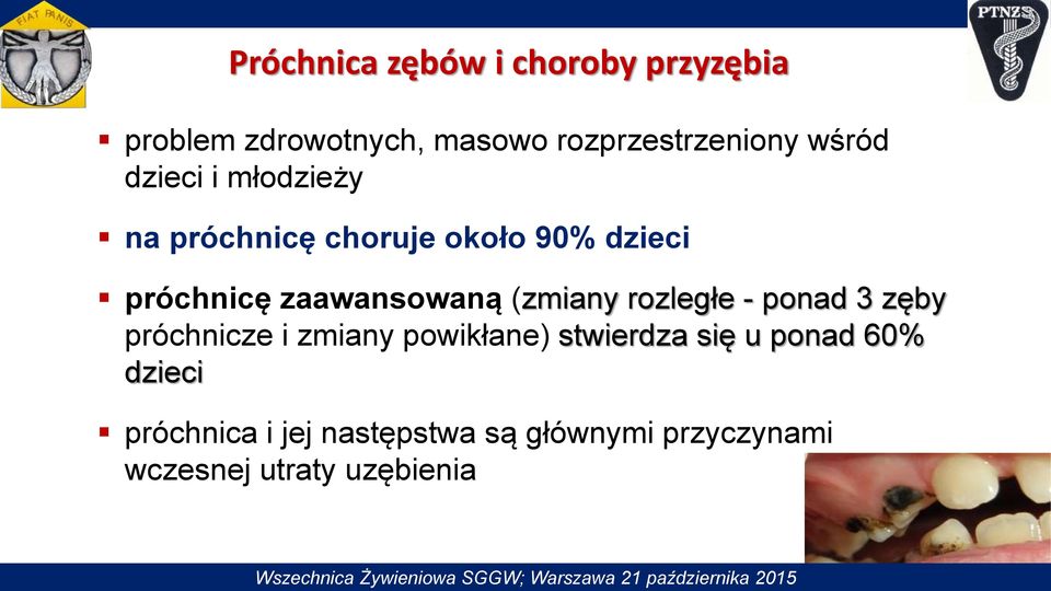 zęby próchnicze i zmiany powikłane) stwierdza się u ponad 60% dzieci próchnica i jej następstwa są