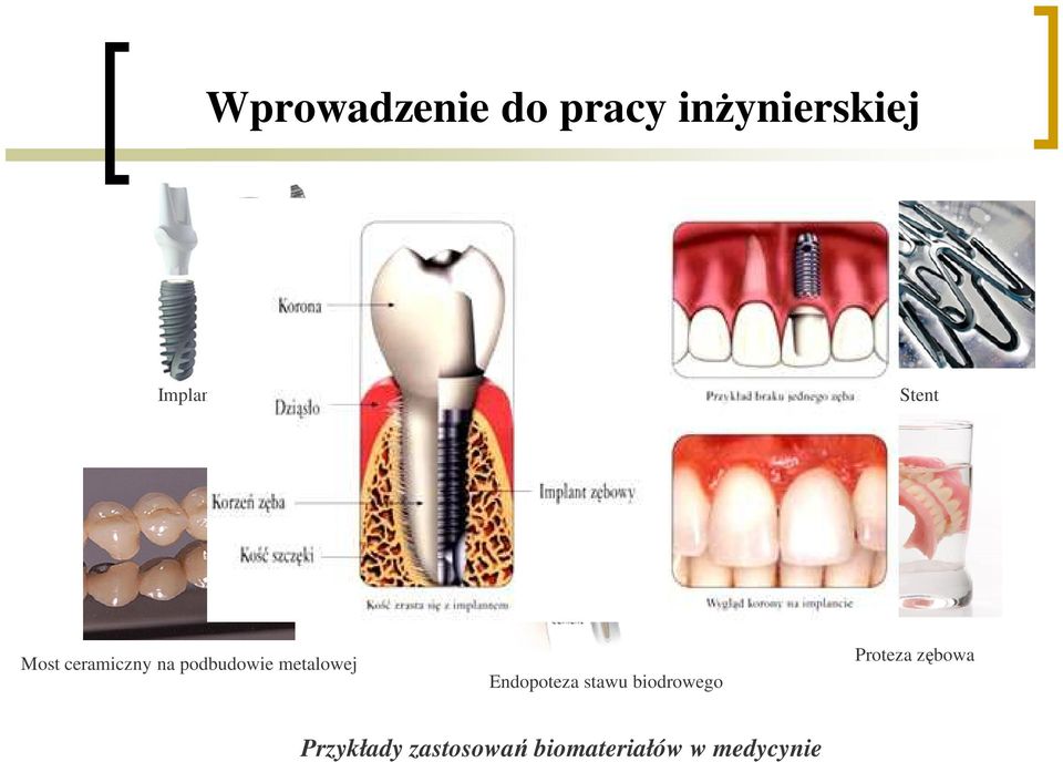 ceramiczny na podbudowie metalowej Endopoteza stawu