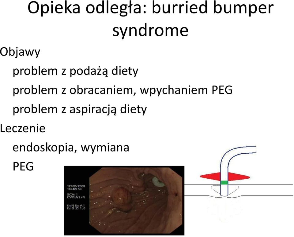 obracaniem, wpychaniem PEG problem z