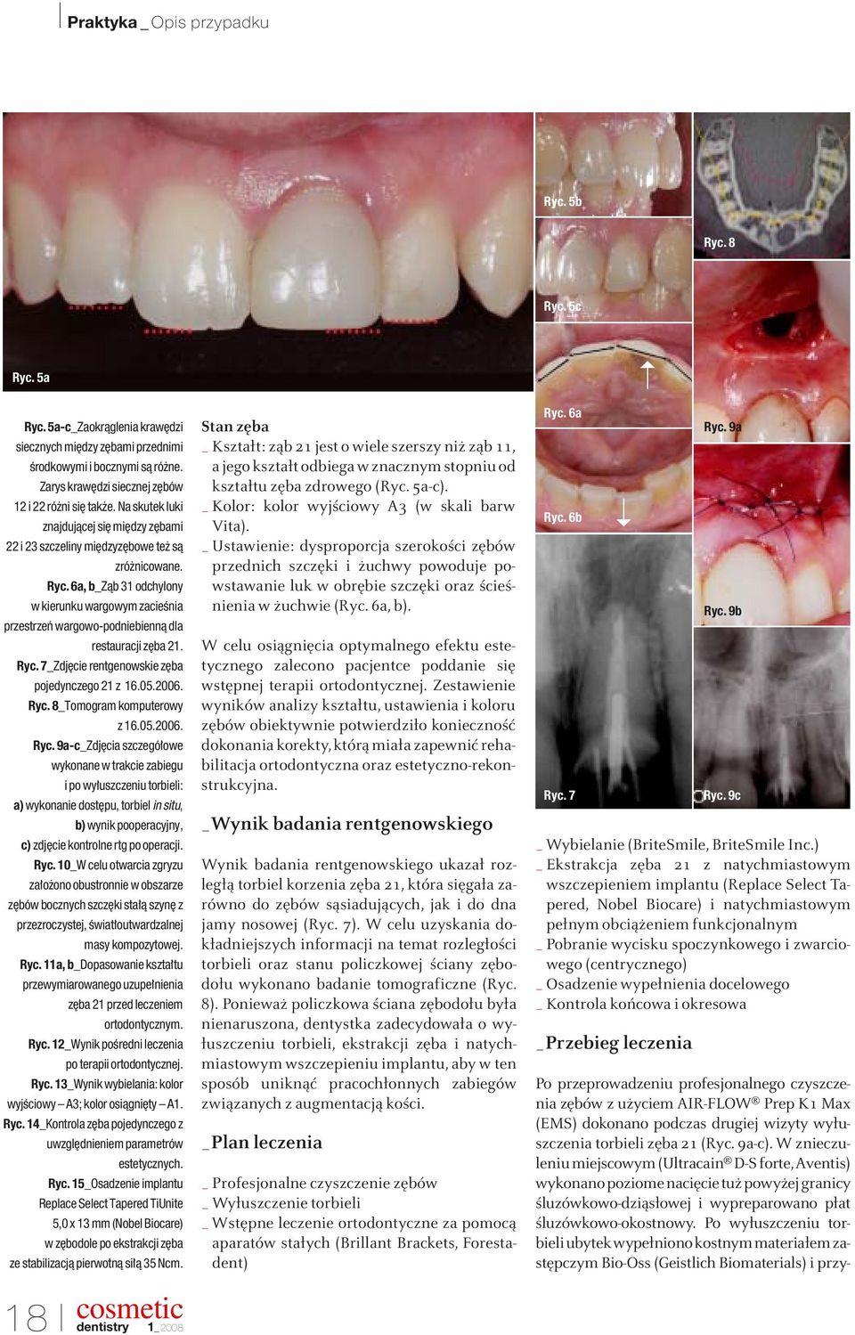 6a, b_zàb 31 odchylony w kierunku wargowym zacieênia przestrzeƒ wargowo-podniebiennà dla restauracji z ba 21. Ryc. 7_Zdj cie rentgenowskie z ba pojedynczego 21 z 16.05.2006. Ryc. 8_Tomogram komputerowy z 16.