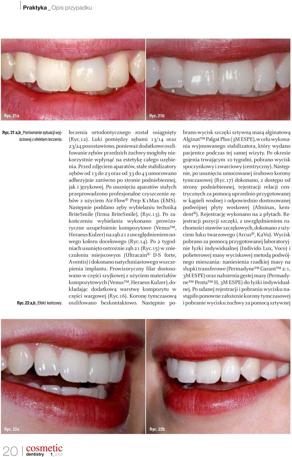 Przed zdjęciem aparatów, stałe stabilizatory zębów od 13 do 23 oraz od 33 do 43 umocowano adhezyjnie zarówno po stronie podniebiennej, jak i językowej.