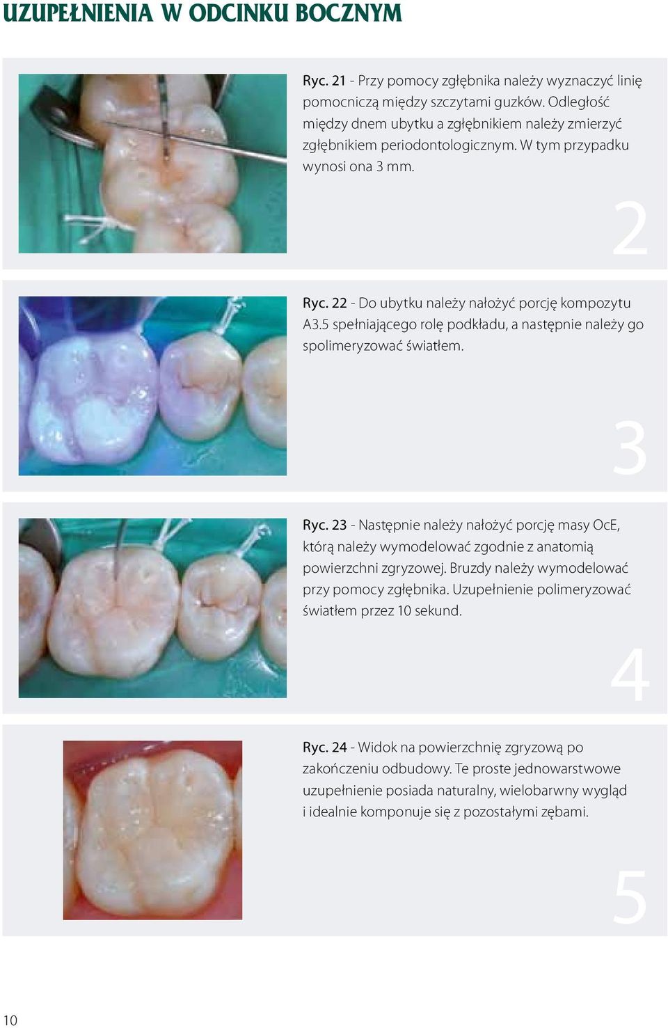 5 spełniającego rolę podkładu, a następnie należy go spolimeryzować światłem. 3 Ryc. 23 - Następnie należy nałożyć porcję masy OcE, którą należy wymodelować zgodnie z anatomią powierzchni zgryzowej.