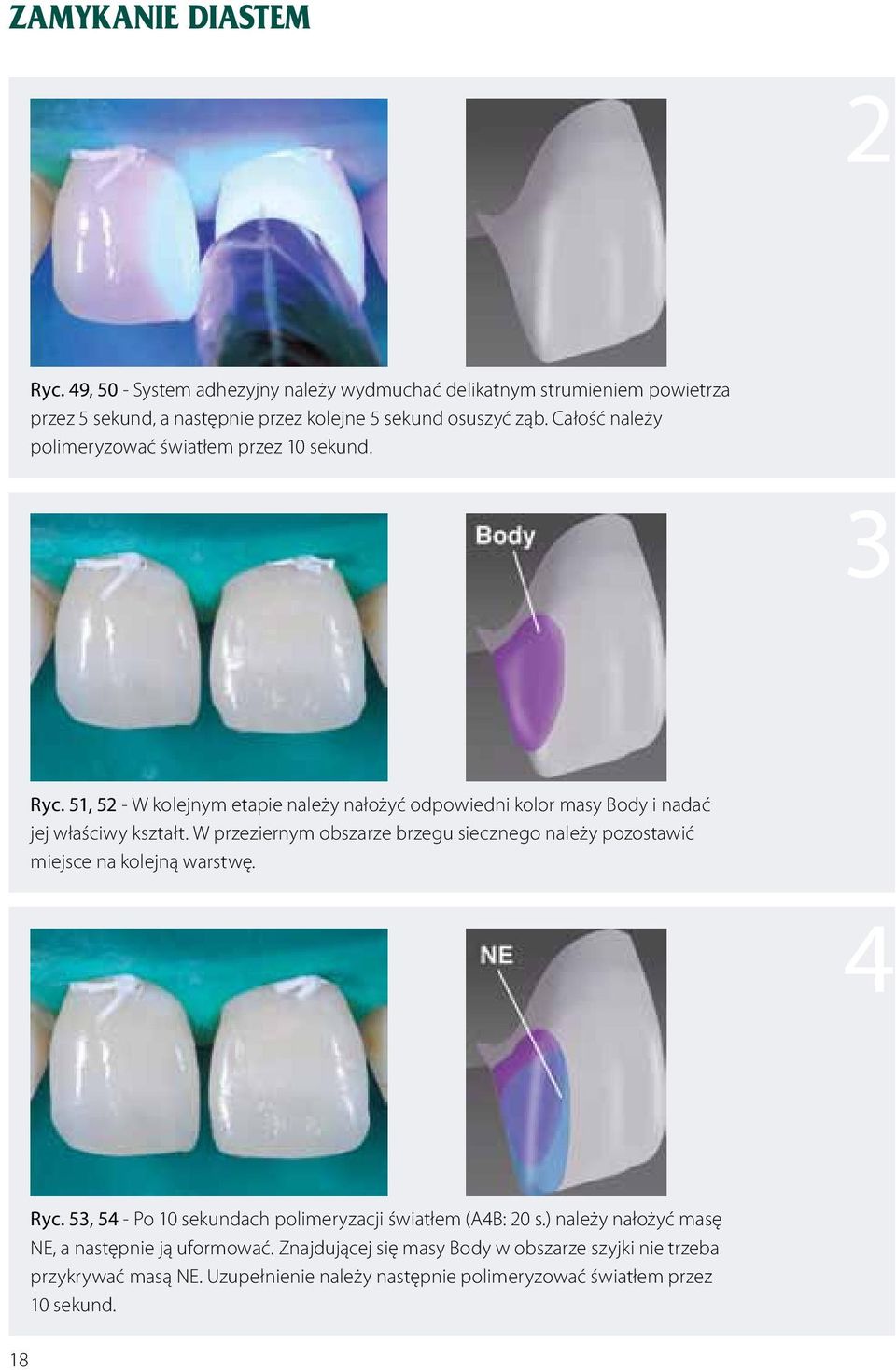 W przeziernym obszarze brzegu siecznego należy pozostawić miejsce na kolejną warstwę. 4 18 Ryc. 53, 54 - Po 10 sekundach polimeryzacji światłem (A4B: 20 s.