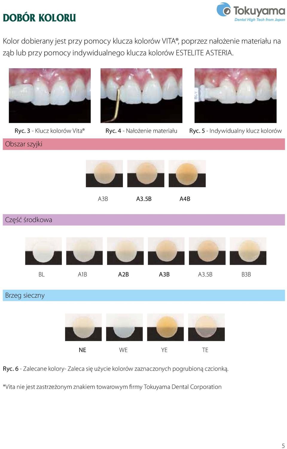 the dobierany material jest on przy the tooth, pomocy or klucza the ESTELITE kolorów VITA, ASTERIA poprzez CUSTOM nałożenie SHADE the material on the tooth, or the ESTELITE ASTERIA CUSTOM SHADE