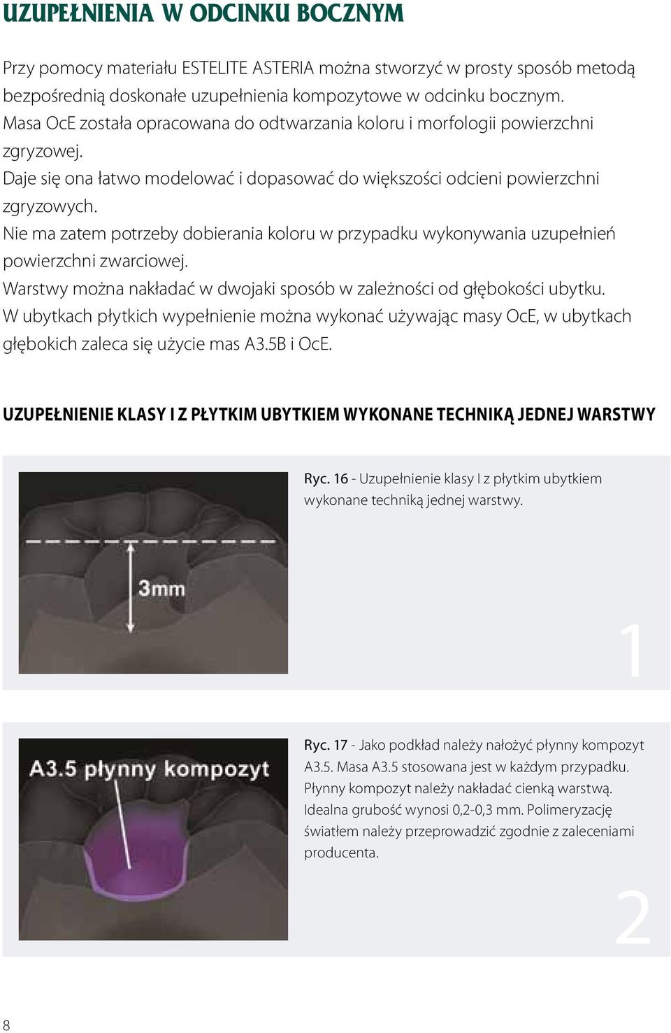 Nie ma zatem potrzeby dobierania koloru w przypadku wykonywania uzupełnień powierzchni zwarciowej. Warstwy można nakładać w dwojaki sposób w zależności od głębokości ubytku.