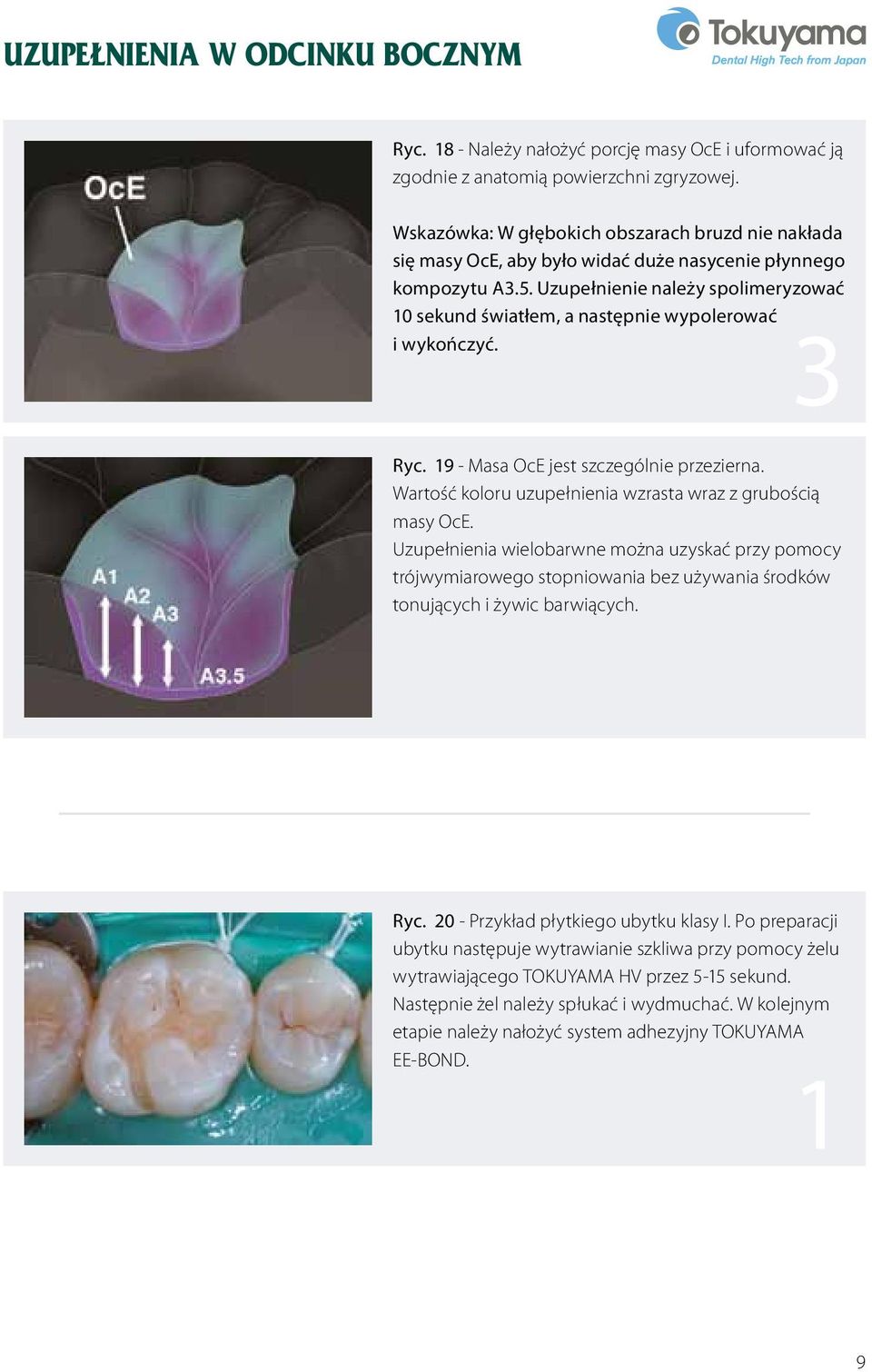 Uzupełnienie należy spolimeryzować 10 sekund światłem, a następnie wypolerować i wykończyć. 3 Ryc. 19 - Masa OcE jest szczególnie przezierna.