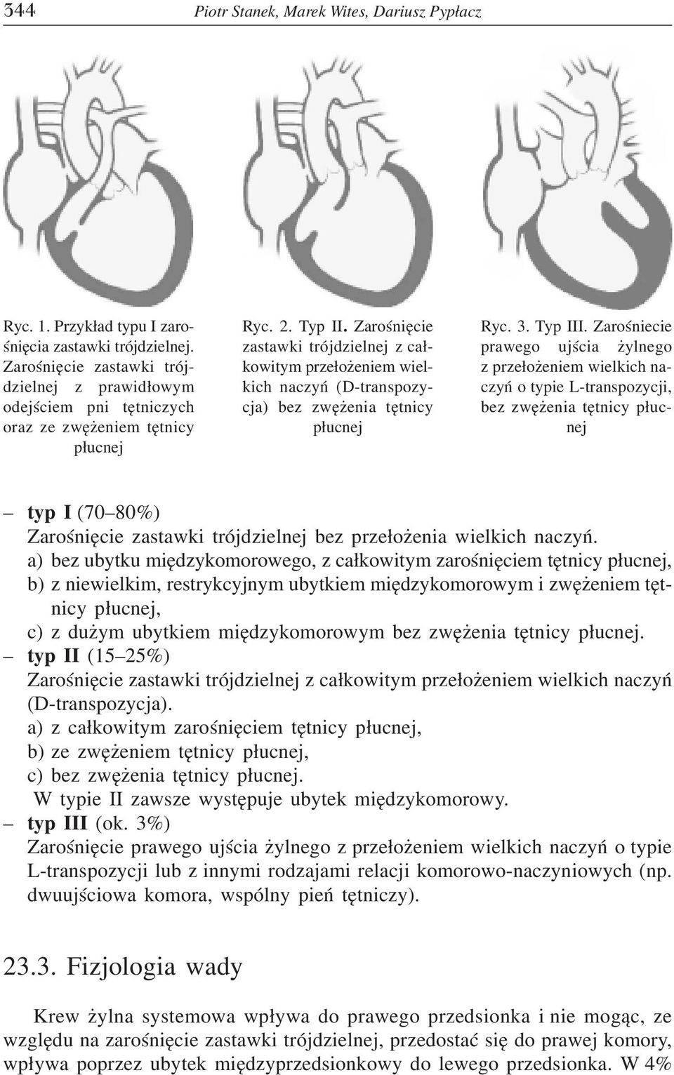 Zaroœniêcie zastawki trójdzielnej z ca³kowitym prze³o eniem wielkich naczyñ (D-transpozycja) bez zwê enia têtnicy p³ucnej Ryc. 3. Typ III.