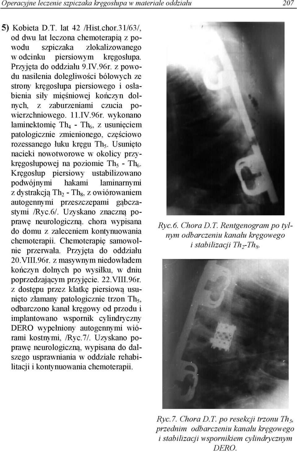 z powodu nasilenia dolegliwości bólowych ze strony kręgosłupa piersiowego i osłabienia siły mięśniowej kończyn dolnych, z zaburzeniami czucia powierzchniowego. 11.IV.96r.