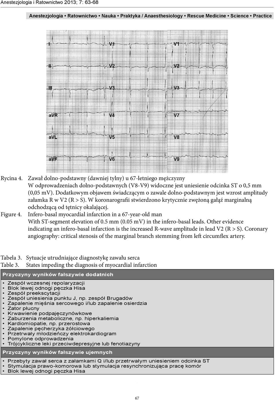 W koronarografii stwierdzono krytycznie zwężoną gałąź marginalną odchodzącą od tętnicy okalającej. Figure 4. Infero-basal myocardial infarction in a 67-year-old man With ST-segment elevation of 0.